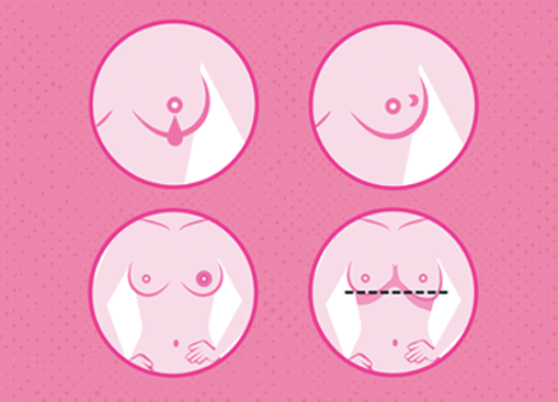 Cztery różowe piktogramy kobiecego tułowia na różowym tle, pokazujące piersi z różnych perspektyw: z profilu i z przodu, z zaznaczonymi brodawkami oraz linią przerywaną wskazującą poziom porównania lub obserwacji symetrii piersi.